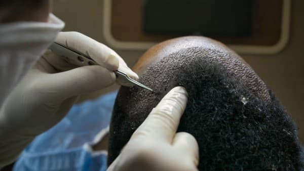زراعة الشعر بتقنية DHI