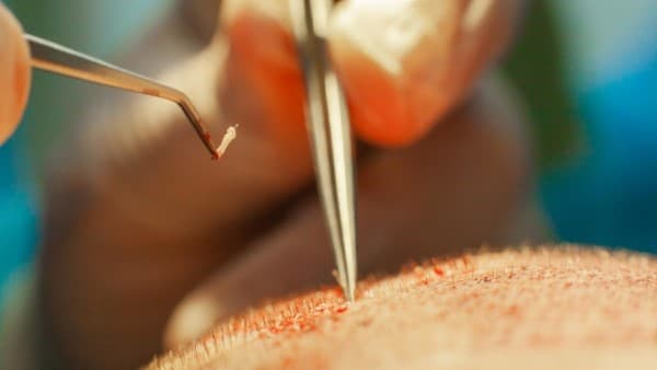 زراعة الشعر بتقنية FUE