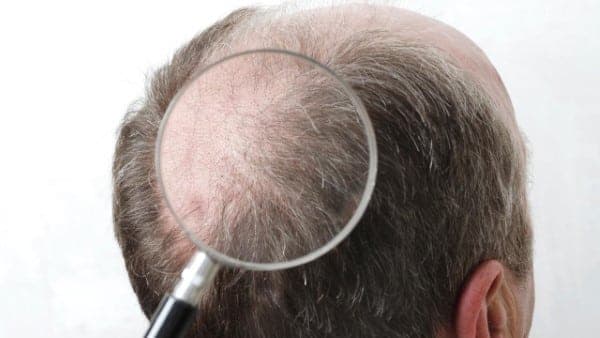 אבחון נשירת שיער והתקרחות