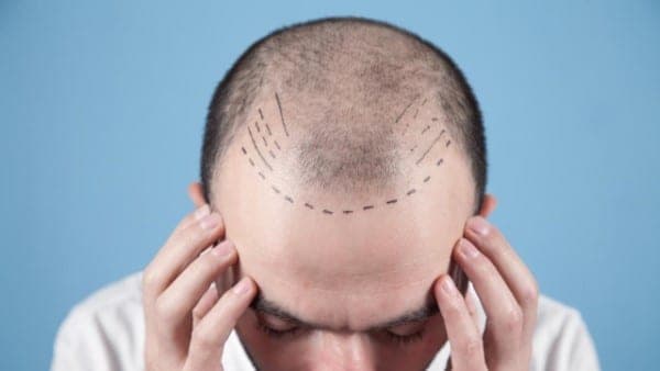 زراعة الشعر للرجال