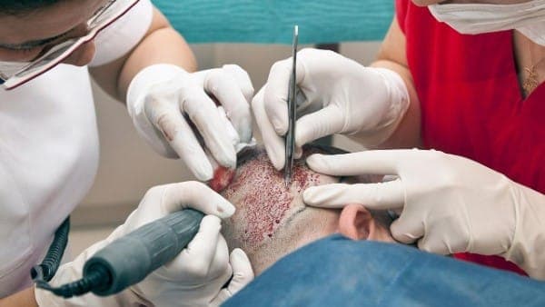 زراعة الشعر في الشمال